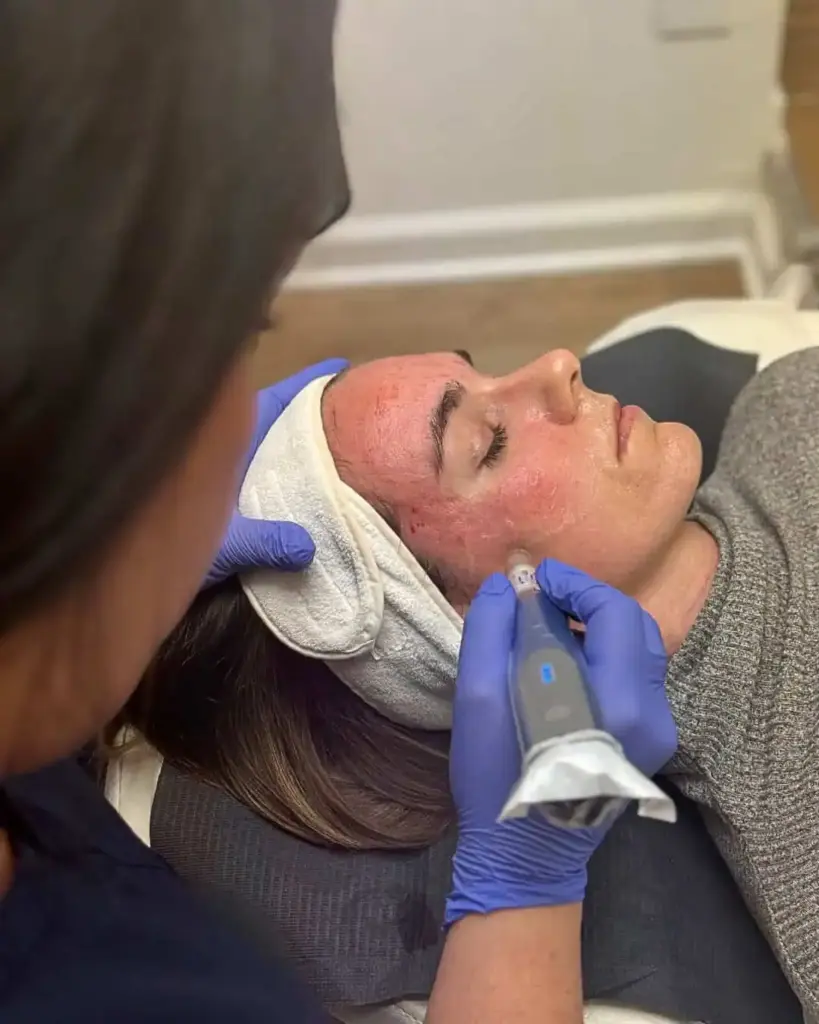 Skin pen | Orchard Park, NY | EMME SKIN STUDIO
