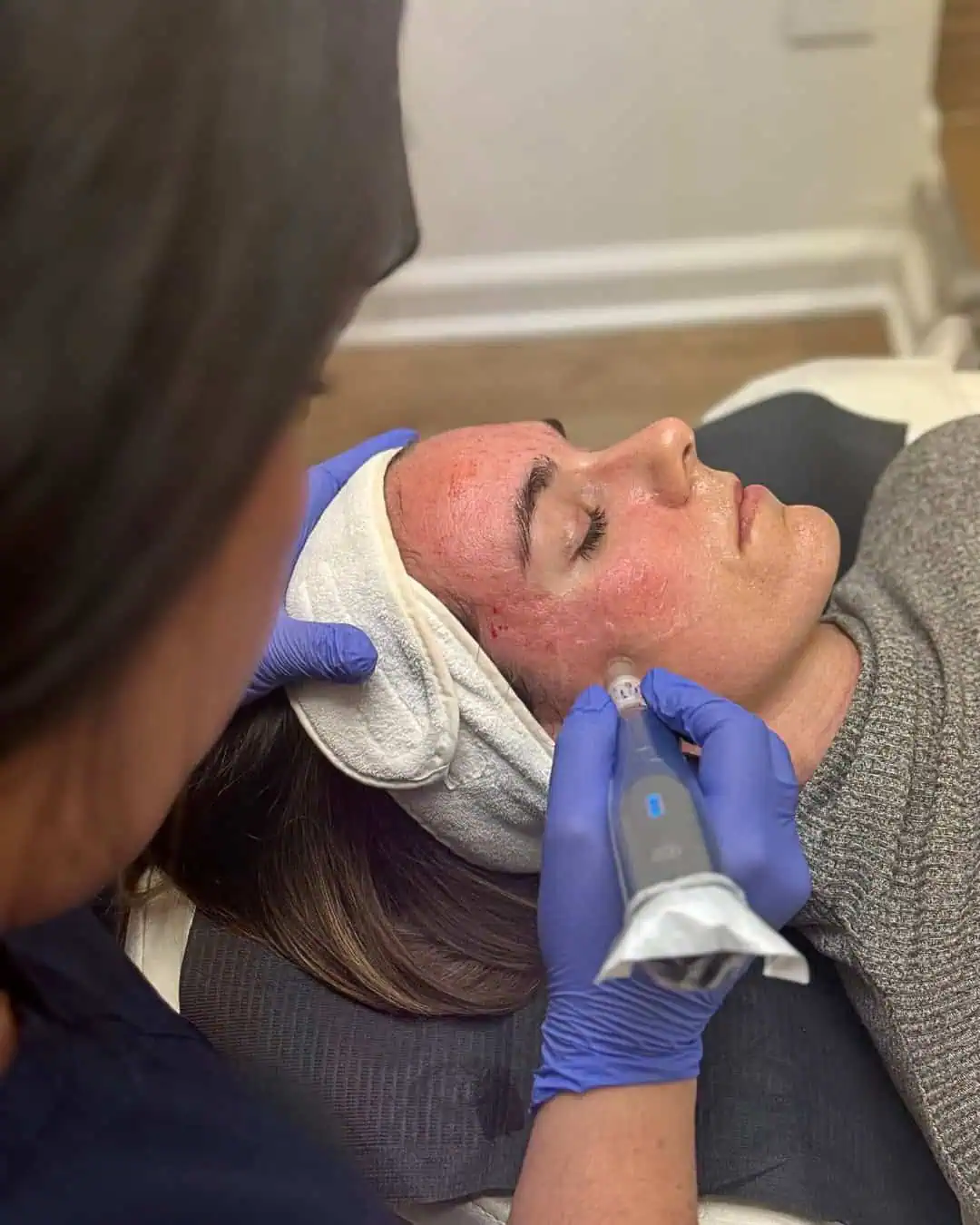 Skin pen | Orchard Park, NY | EMME SKIN STUDIO