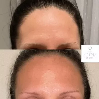Xeomin0 | EMME Medical Spa | Orchard Park, NY