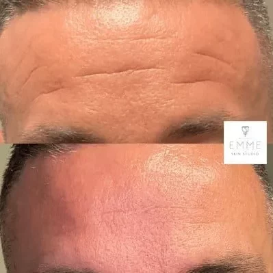 XeominA | EMME Medical Spa | Orchard Park, NY