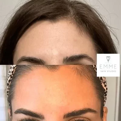 XeominCC-one | EMME Medical Spa | Orchard Park, NY