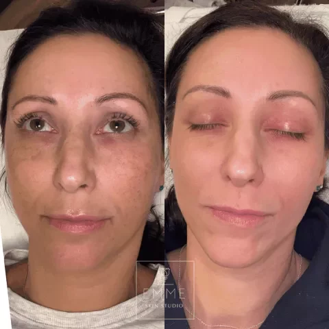 Zo-Skin-Before-After | EMME Medical Spa | Orchard Park, NY