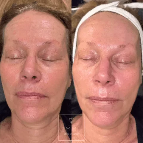 Zo-Skin-Before-After | EMME Medical Spa | Orchard Park, NY