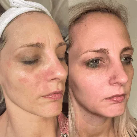 Zo-Skin-Before-After | EMME Medical Spa | Orchard Park, NY