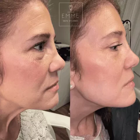 Zo-Skin-Before-After | EMME Medical Spa | Orchard Park, NY