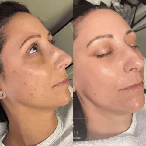 Zo-Skin-Before-After | EMME Medical Spa | Orchard Park, NY