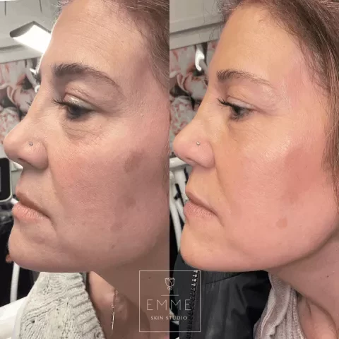 Zo-Skin-Before-After | EMME Medical Spa | Orchard Park, NY