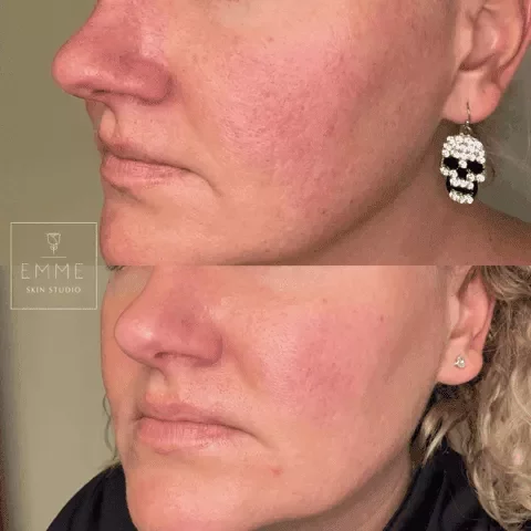 Zo-Skin-Before-After | EMME Medical Spa | Orchard Park, NY