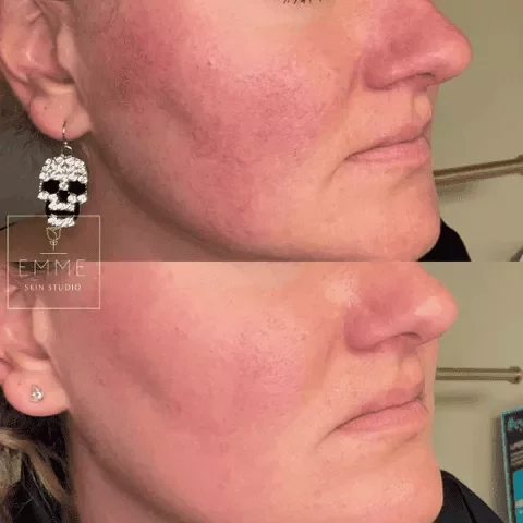 Zo-Skin-Before-After | EMME Medical Spa | Orchard Park, NY