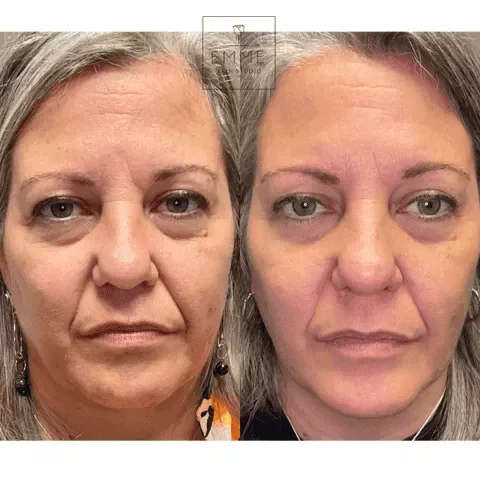 Zo-Skin-Before-After | EMME Medical Spa | Orchard Park, NY