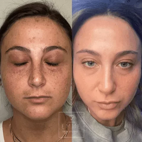 Zo-Skin-Before-After | EMME Medical Spa | Orchard Park, NY