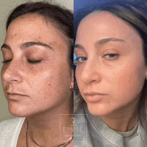 Zo-Skin-Before-After | EMME Medical Spa | Orchard Park, NY