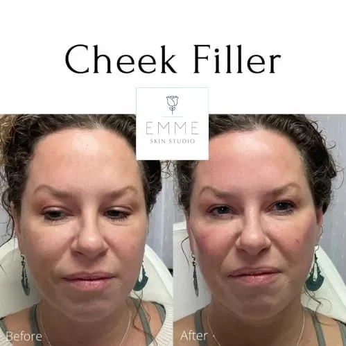 Fillers Before And After | EMME Medical Spa | Orchard Park, NY