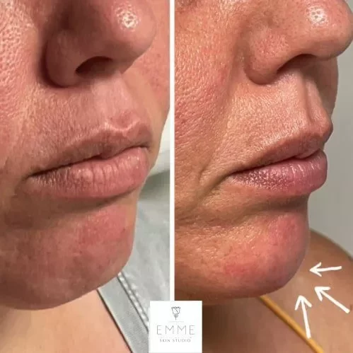 Fillers Before And After | EMME Medical Spa | Orchard Park, NY