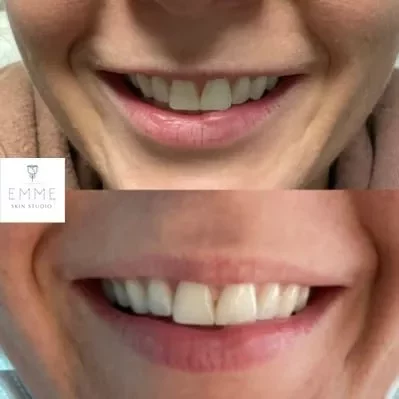 Xeomin-a-before-and-after | EMME Medical Spa | Orchard Park, NY