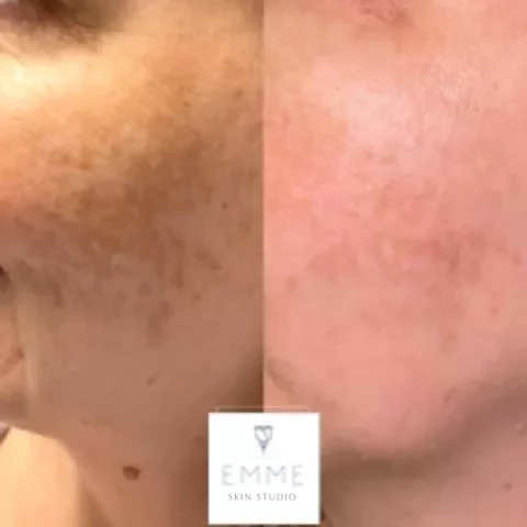 Emmedmedicalspa-zoskin | EMME Medical Spa | Orchard Park, NY