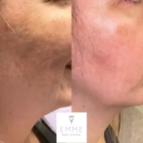 Emmedmedicalspa-zoskin | EMME Medical Spa | Orchard Park, NY