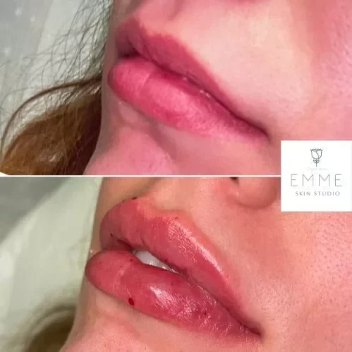 Fillers Before And After | EMME Medical Spa | Orchard Park, NY
