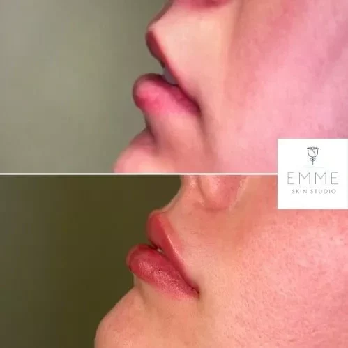 Fillers Before And After | EMME Medical Spa | Orchard Park, NY