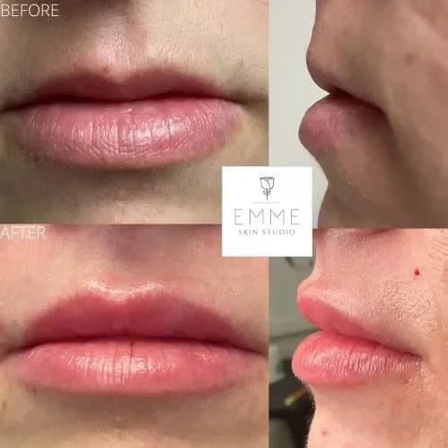Injectables-d-before-and-after | EMME Medical Spa | Orchard Park, NY