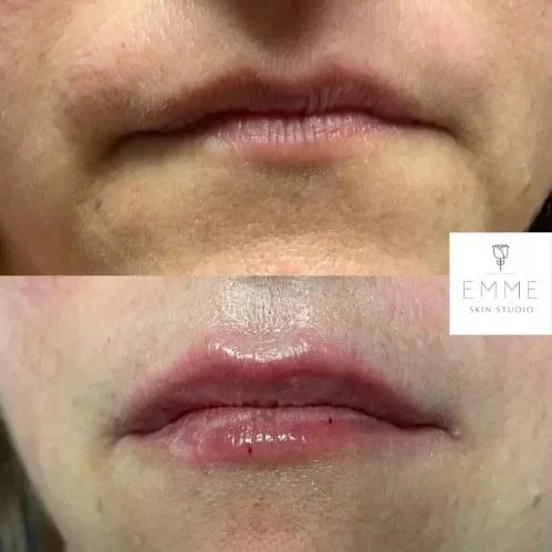 Injectables-d-before-and-after | EMME Medical Spa | Orchard Park, NY