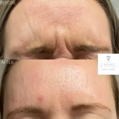 xeomin | EMME Medical Spa | Orchard Park, NY