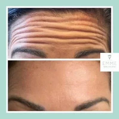 xeomin-am-before-and-afte | EMME Medical Spa | Orchard Park, NY