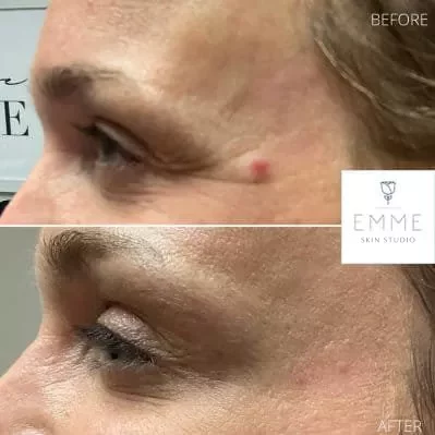 xeomin-h-before-and-afte | EMME Medical Spa | Orchard Park, NY