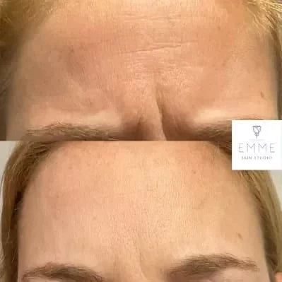 xeomin-h-before-and-afte | EMME Medical Spa | Orchard Park, NY